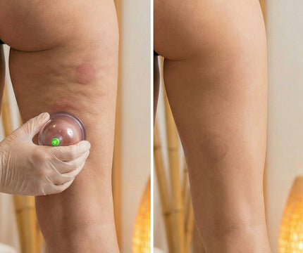 Profesionalios kiniškos masažo taurelės Soulima – tradicinė cupping terapija grožio salone
